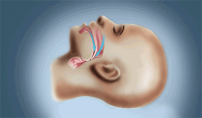 Syndrôme de l'apnée obstructive du sommeil (SAOS)
